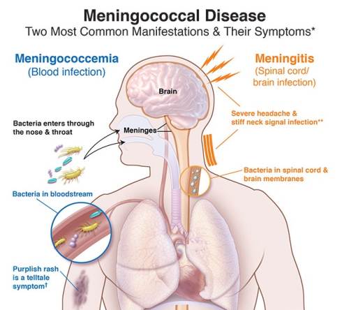 The diagram shows the two most common manifestations of meningococcal diseases and its symptoms. Picture: SUPPLIED