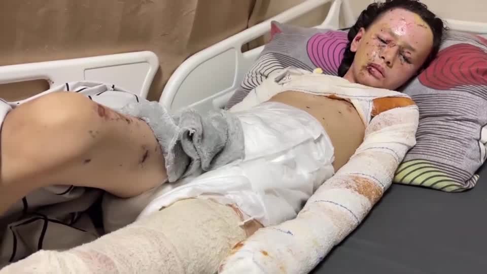 Palestinian girl with burns from Israeli shelling hopes for treatment