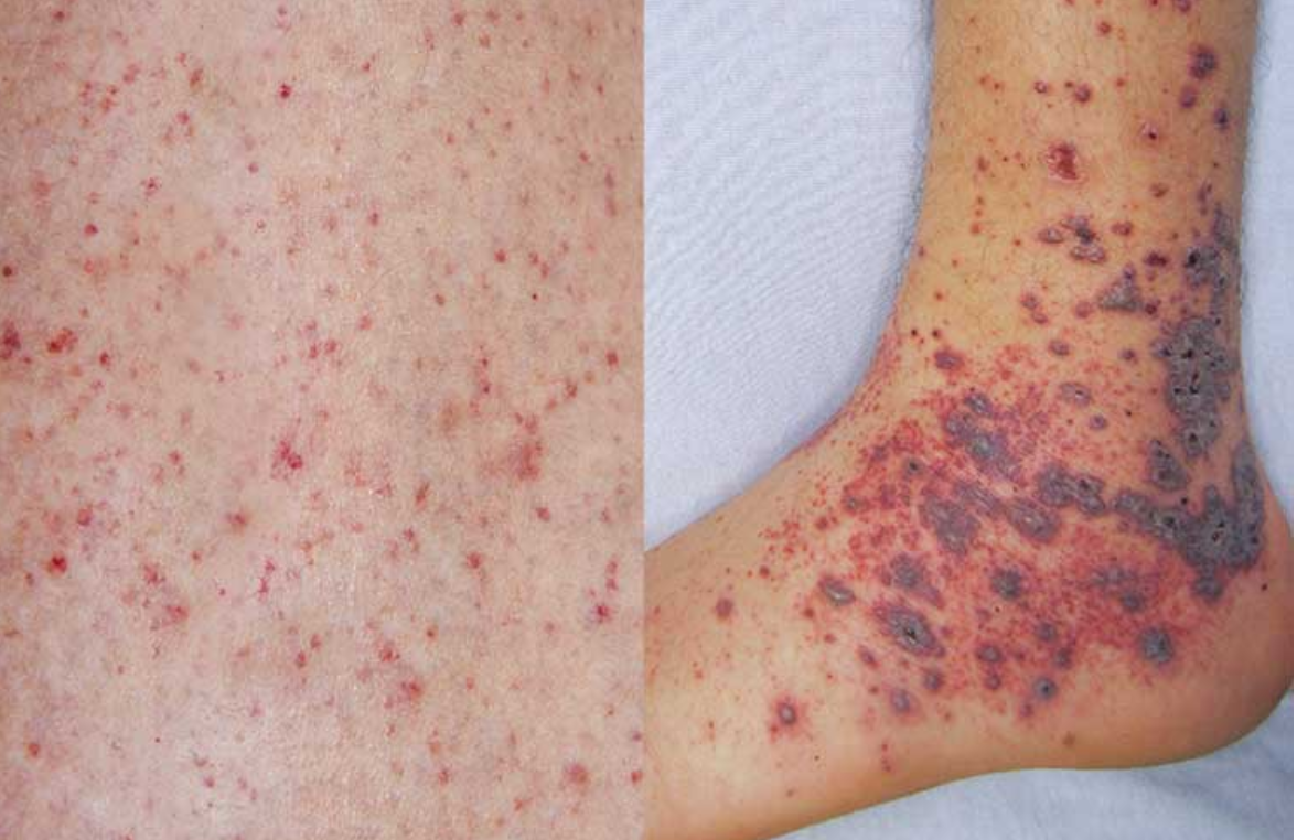 Health centre reopens after suspected meningococcal case